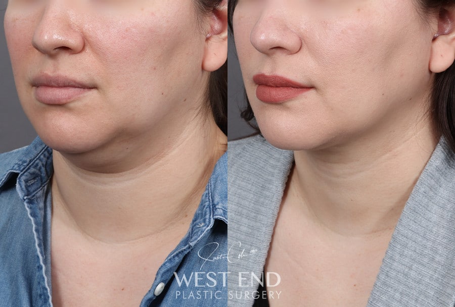 Submental Liposuction before photo. Individual results may vary.