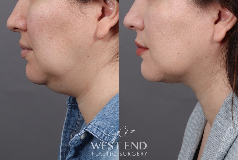 Submental Liposuction before photo. Individual results may vary.