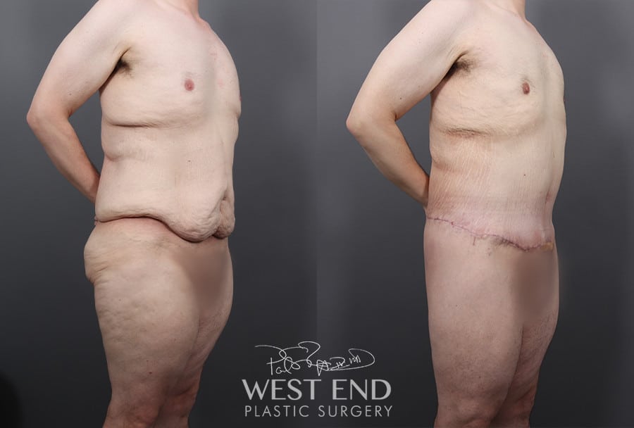 Post Weight Loss: Lower Body Lift, Liposuction & Renuvion Skin Tightening