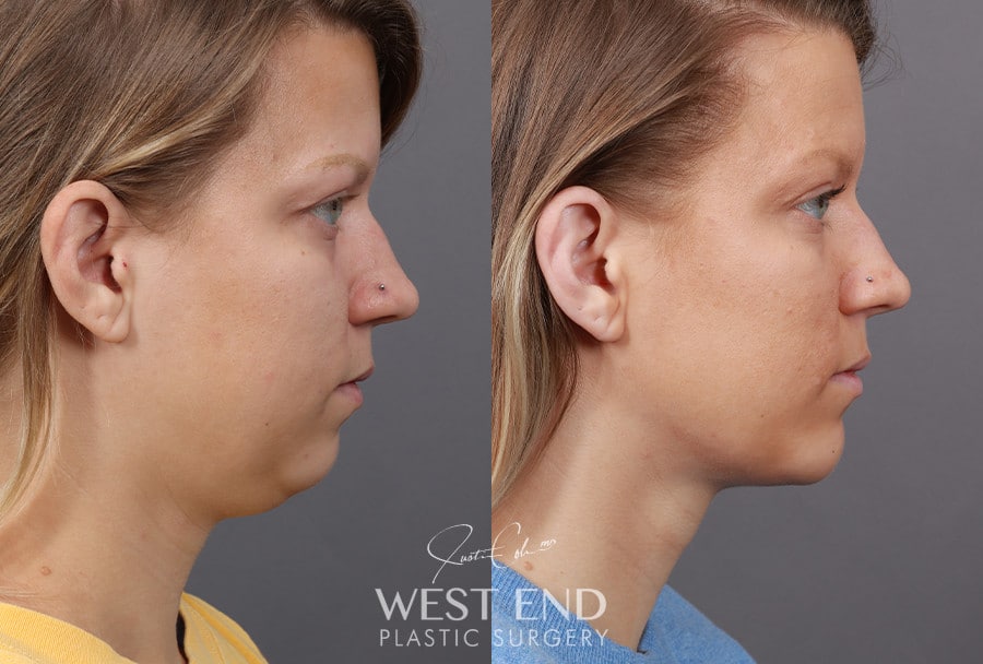 Liposuction & Chin Implant before photo. Individual results may vary.