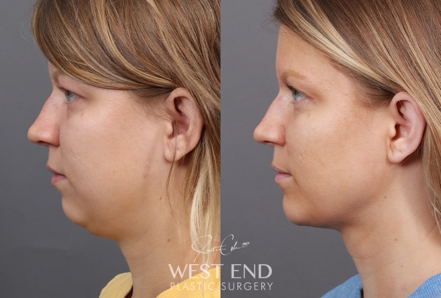 Liposuction & Chin Implant before photo. Individual results may vary.