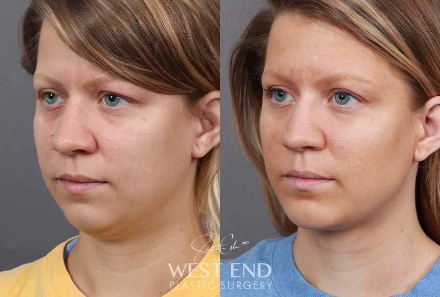 Liposuction & Chin Implant before photo. Individual results may vary.