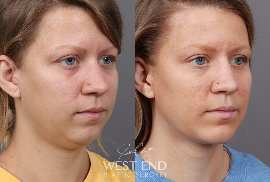 Liposuction & Chin Implant before photo. Individual results may vary.