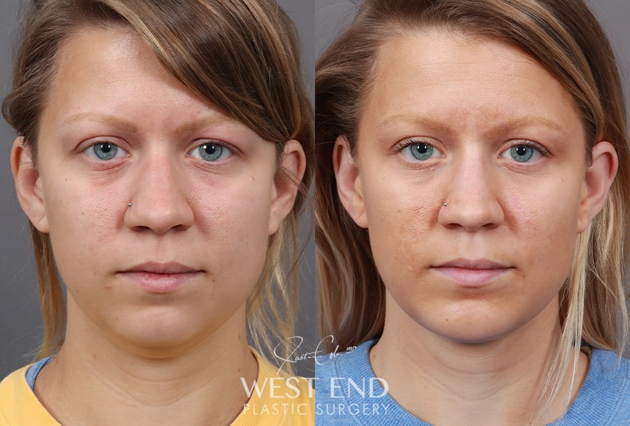Liposuction & Chin Implant before photo. Individual results may vary.