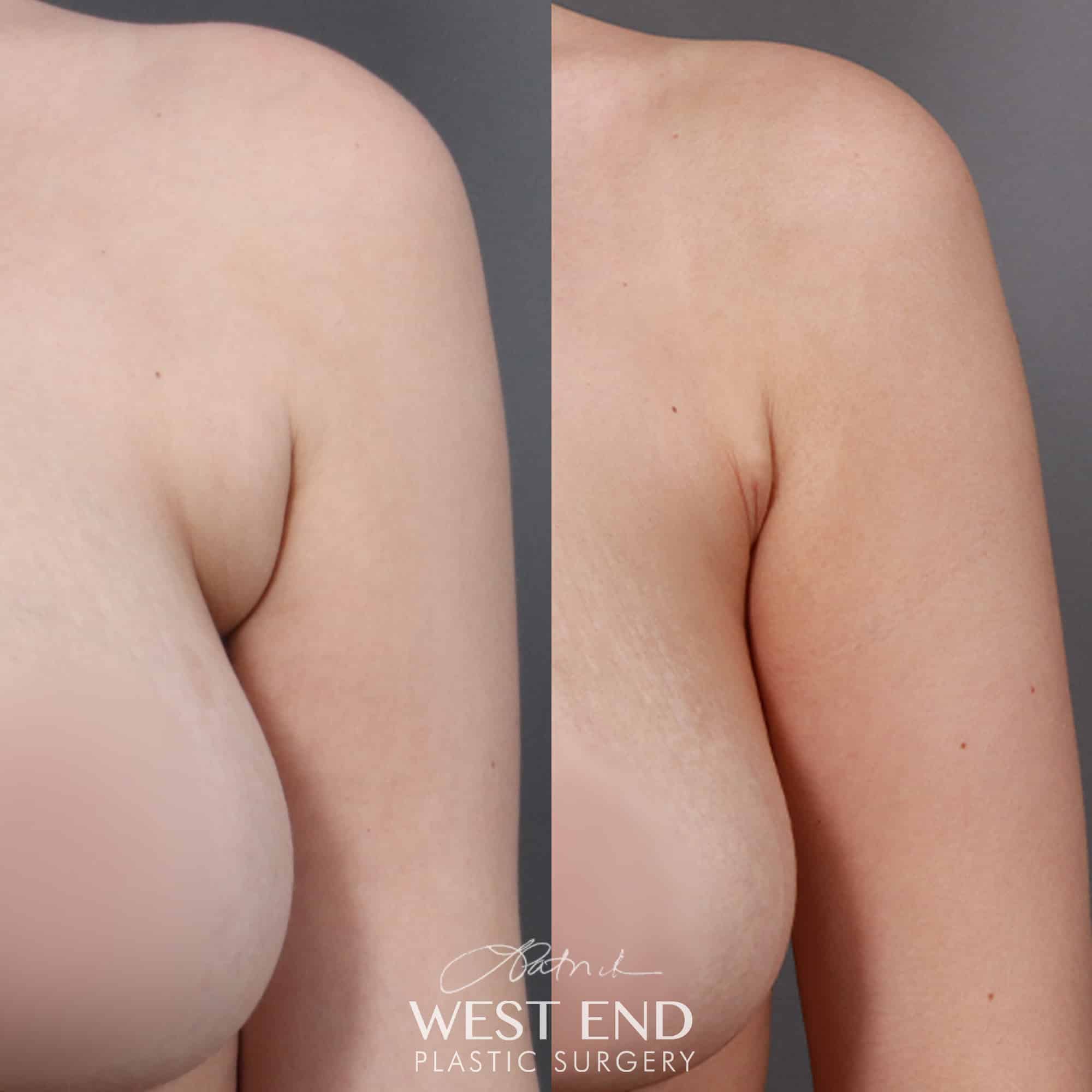Liposuction