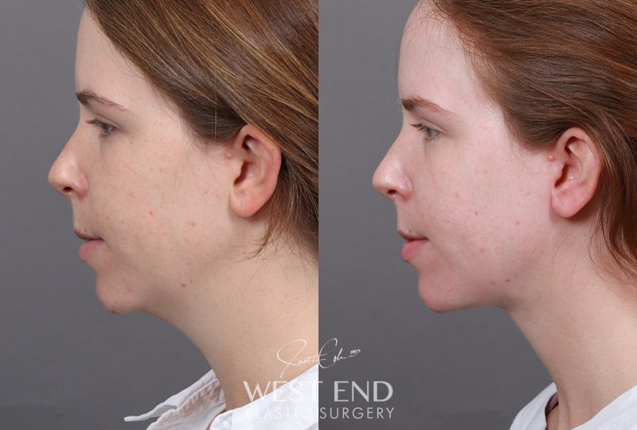 Neck Lift and Liposuction before photo. Individual results may vary.
