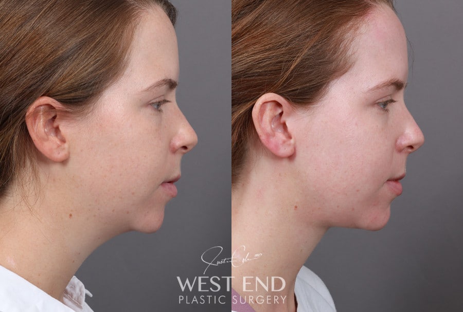 Neck Lift and Liposuction before photo. Individual results may vary.