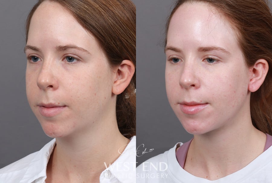 Neck Lift and Liposuction before photo. Individual results may vary.