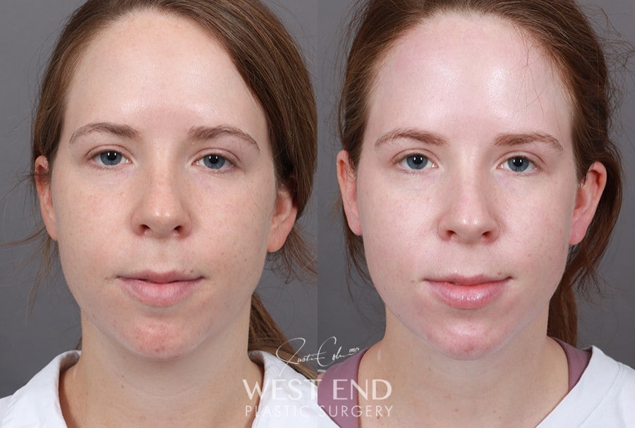 Neck Lift and Liposuction before photo. Individual results may vary.