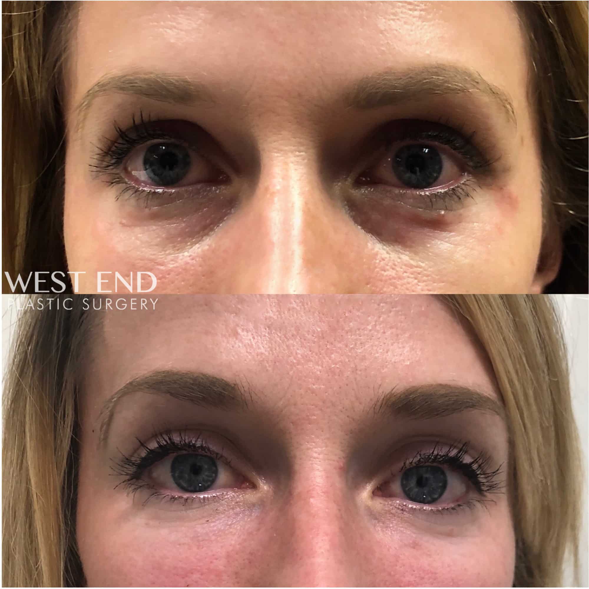 Under-Eye Filler
