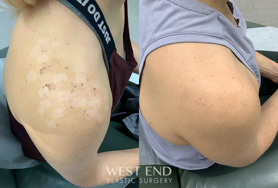 LED Light Therapy & Growth Factors