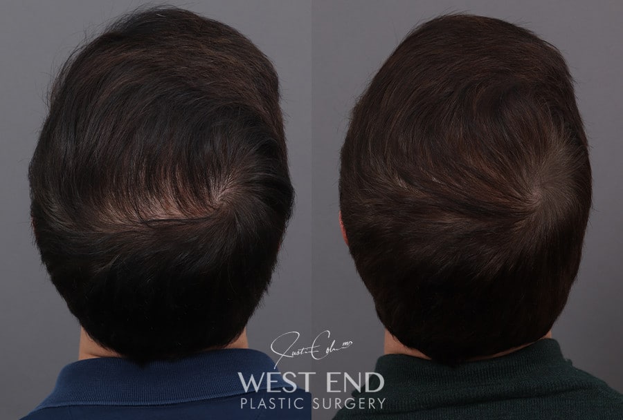 Non-Surgical Hair Restoration with PRP before photo. Individual results may vary.