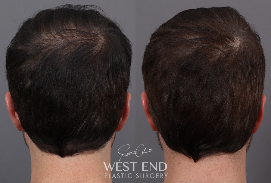 Non-Surgical Hair Restoration with PRP before photo. Individual results may vary.
