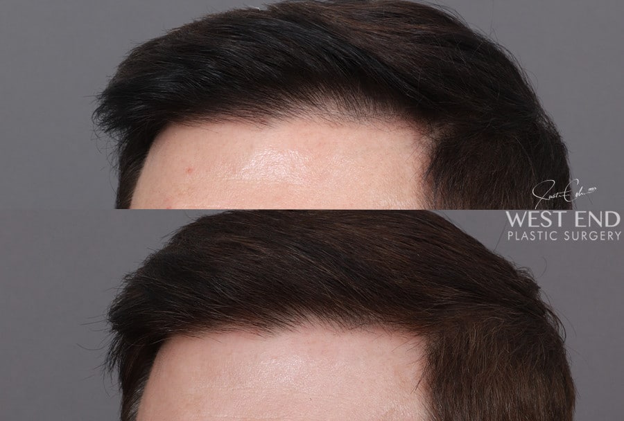 Non-Surgical Hair Restoration with PRP before photo. Individual results may vary.