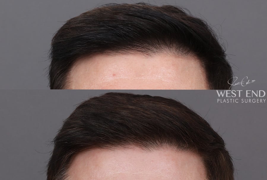 Non-Surgical Hair Restoration with PRP before photo. Individual results may vary.
