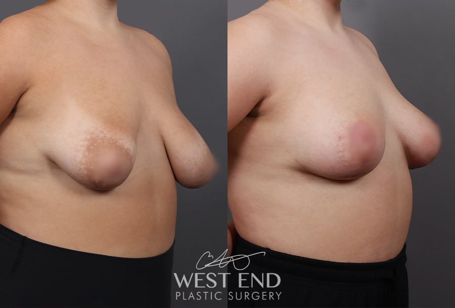 Breast Lift with Fat Grafting