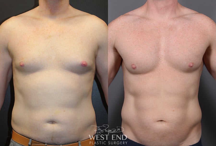 Pectoral Implants, Liposuction & Renuvion Skin Tightening before photo. Individual results may vary.