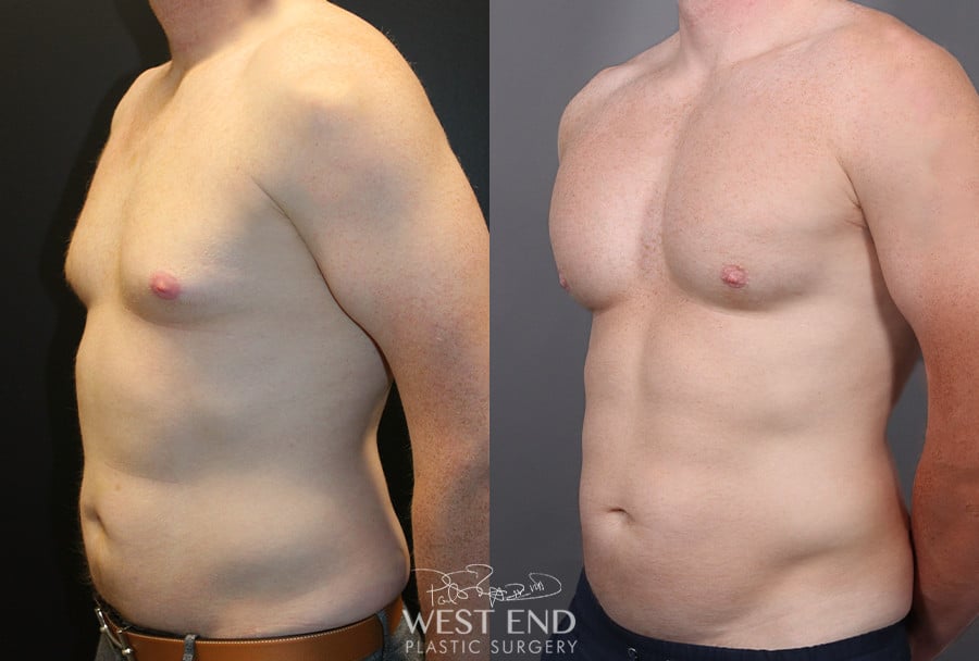 Pectoral Implants, Liposuction & Renuvion Skin Tightening before photo. Individual results may vary.