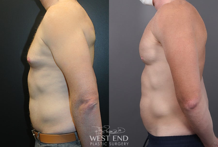 Pectoral Implants, Liposuction & Renuvion Skin Tightening before photo. Individual results may vary.
