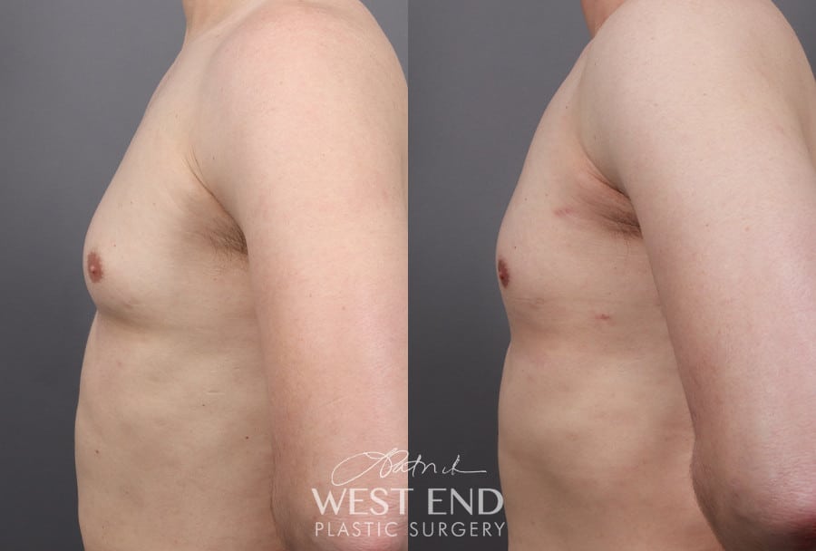 Gynecomastia (with Liposuction & Renuvion) before photo. Individual results may vary.