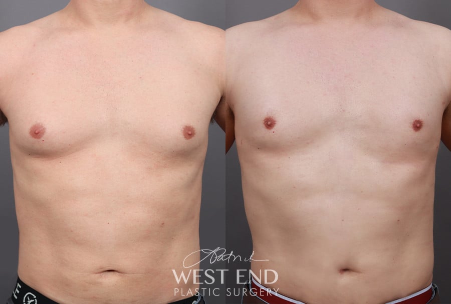 Gynecomastia (with Liposuction & Renuvion) before photo. Individual results may vary.