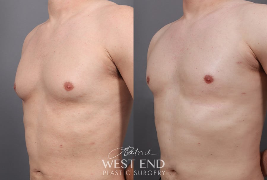 Gynecomastia (with Liposuction & Renuvion) before photo. Individual results may vary.