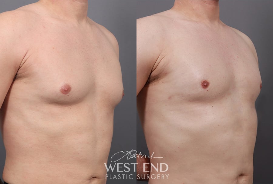 Gynecomastia (with Liposuction & Renuvion) before photo. Individual results may vary.