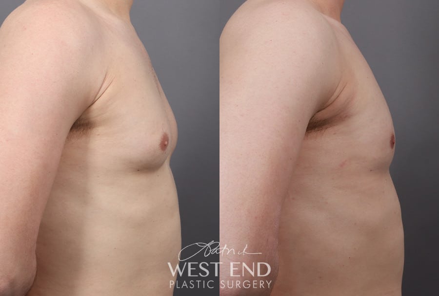 Gynecomastia (with Liposuction & Renuvion) before photo. Individual results may vary.