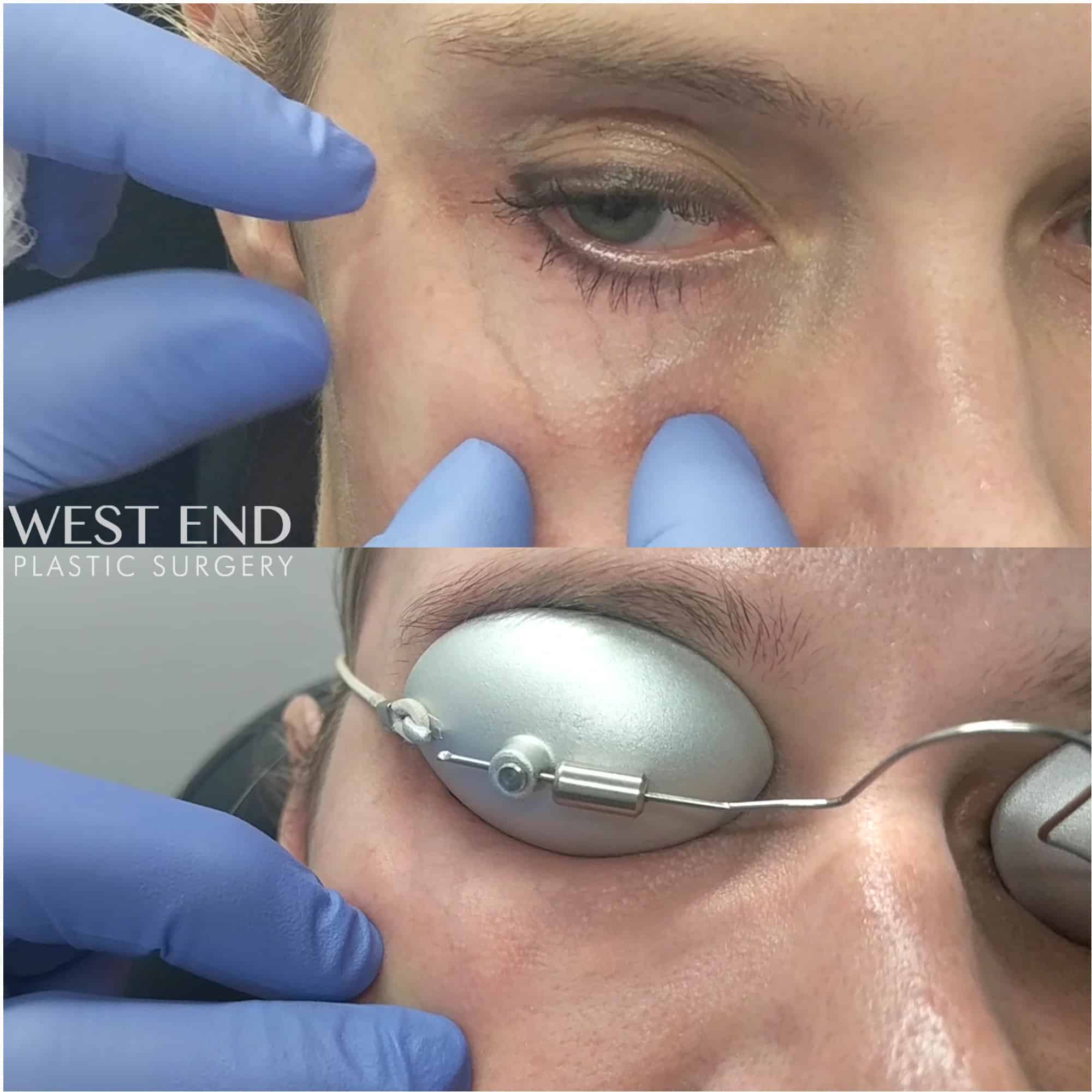 Under Eye Vein Removal with the Cutera YAG Laser