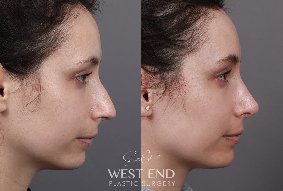 Revision Rhinoplasty before photo. Individual results may vary.