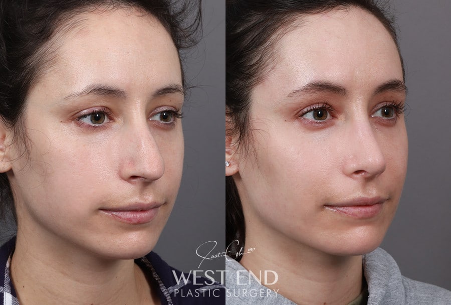 Revision Rhinoplasty before photo. Individual results may vary.