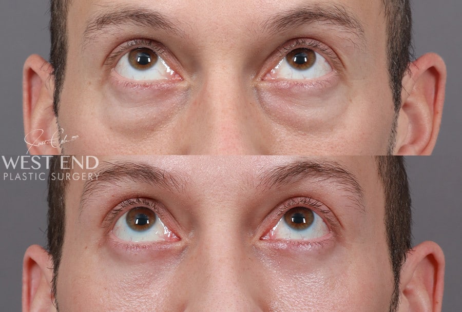 Blepharoplasty before photo. Individual results may vary.