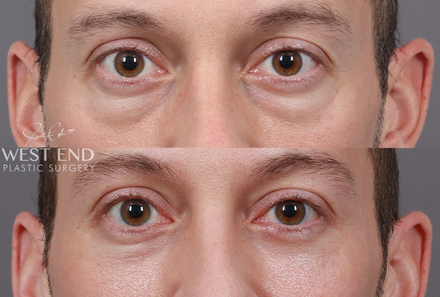 Blepharoplasty before photo. Individual results may vary.