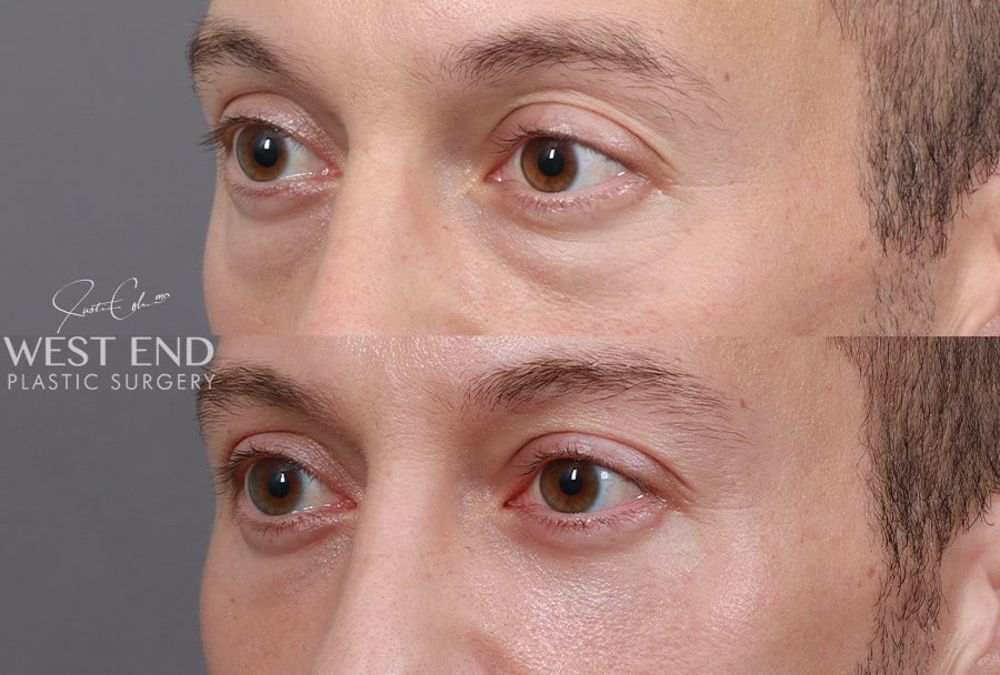 Blepharoplasty before photo. Individual results may vary.