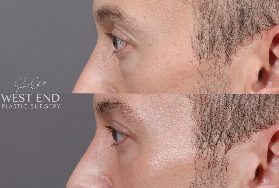 Blepharoplasty before photo. Individual results may vary.
