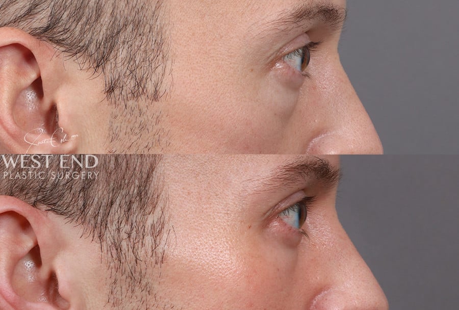 Blepharoplasty before photo. Individual results may vary.