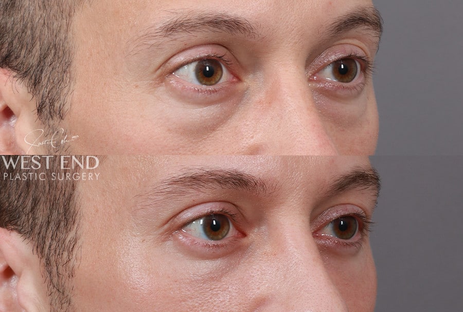 Blepharoplasty before photo. Individual results may vary.