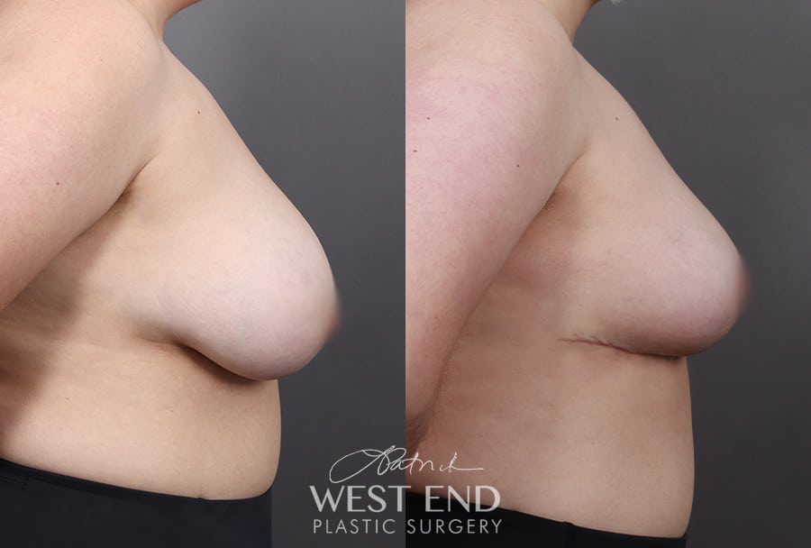 Breast Reduction