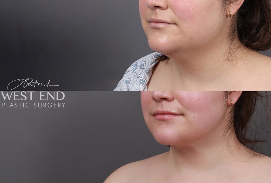 Submental Liposuction