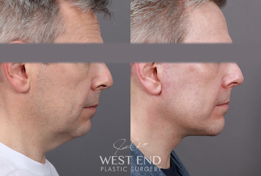 Extended Deep Plane Facelift, Neck Lift & Chin Implant before photo. Individual results may vary.