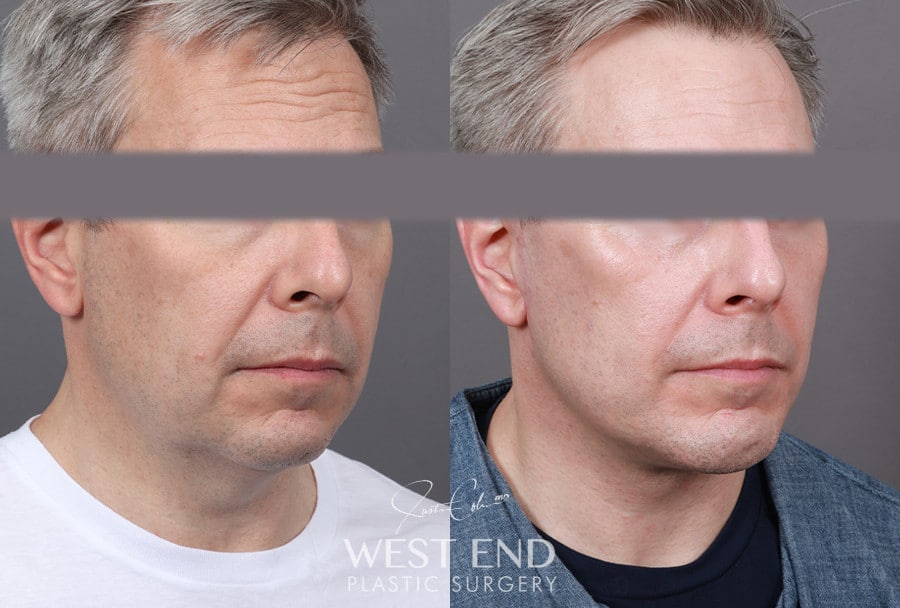 Extended Deep Plane Facelift, Neck Lift & Chin Implant before photo. Individual results may vary.