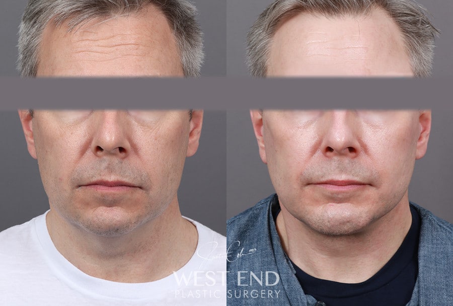 Extended Deep Plane Facelift, Neck Lift & Chin Implant before photo. Individual results may vary.