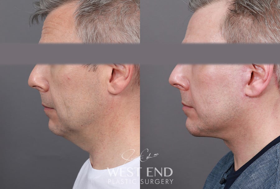Extended Deep Plane Facelift, Neck Lift & Chin Implant before photo. Individual results may vary.