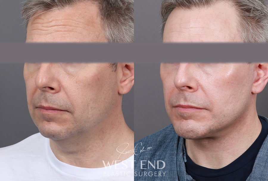 Extended Deep Plane Facelift, Neck Lift & Chin Implant before photo. Individual results may vary.