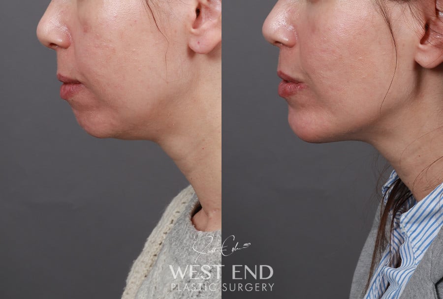 Chin Implant before photo. Individual results may vary.