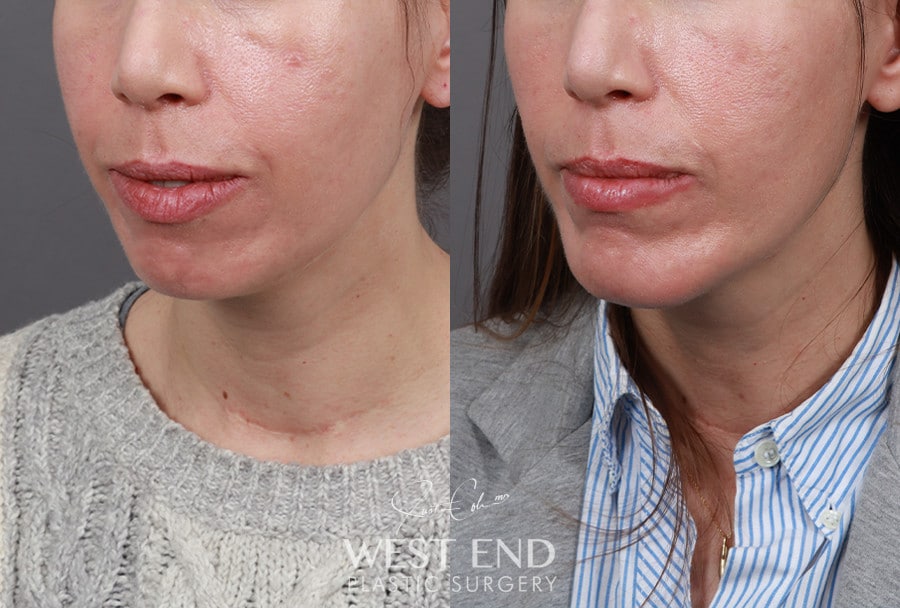 Chin Implant before photo. Individual results may vary.