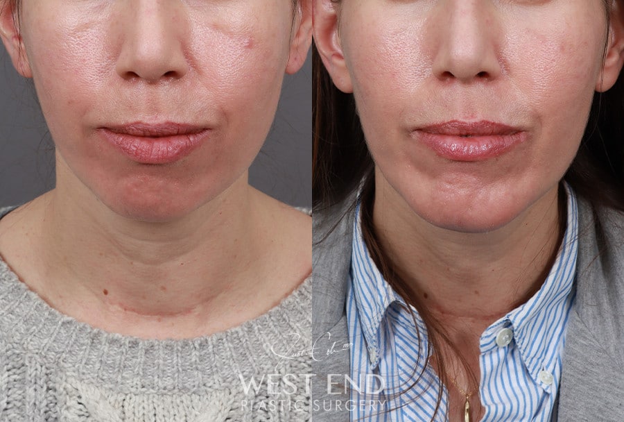 Chin Implant before photo. Individual results may vary.