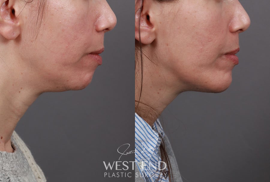 Chin Implant before photo. Individual results may vary.