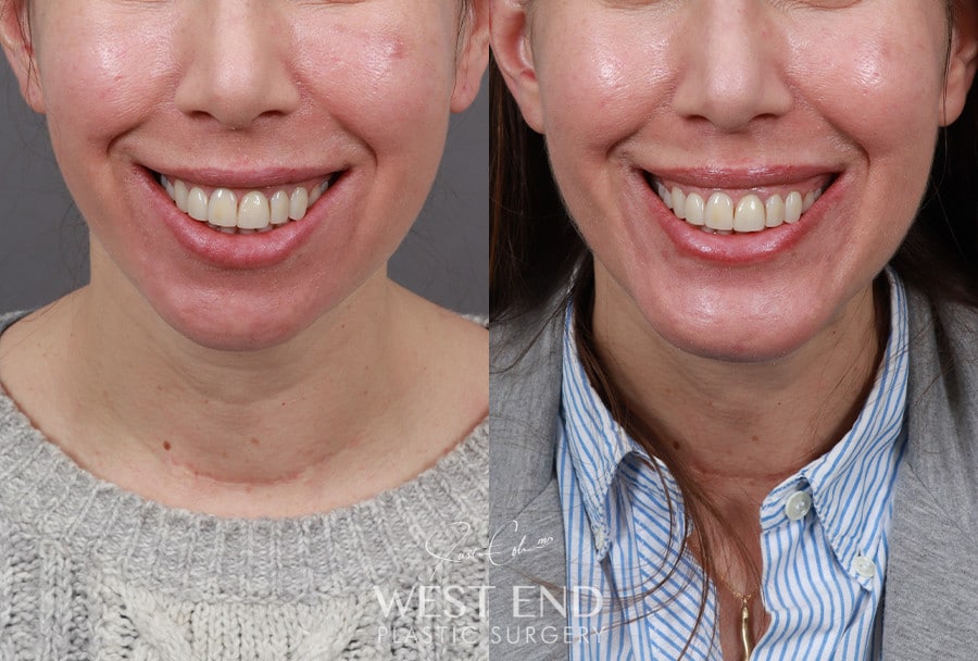 Chin Implant before photo. Individual results may vary.