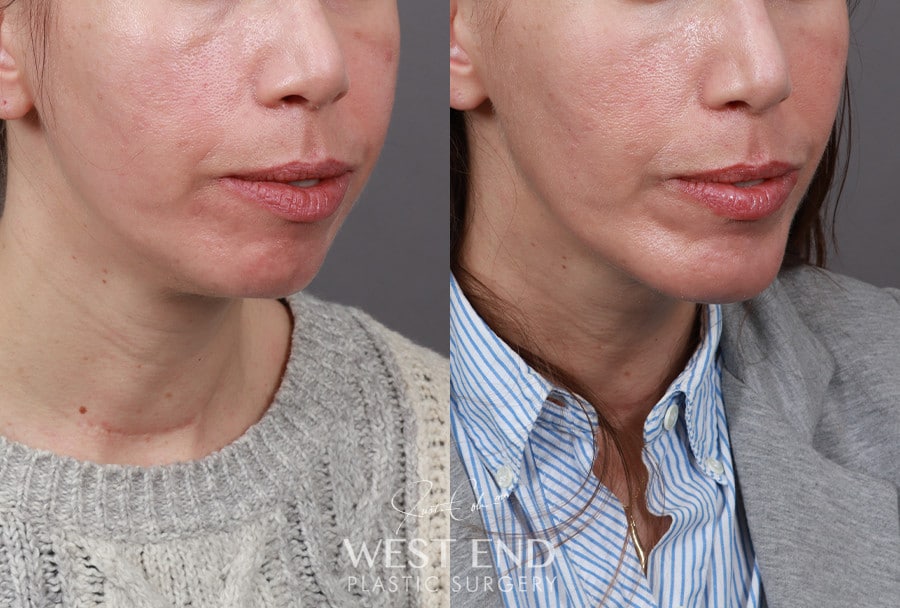 Chin Implant before photo. Individual results may vary.